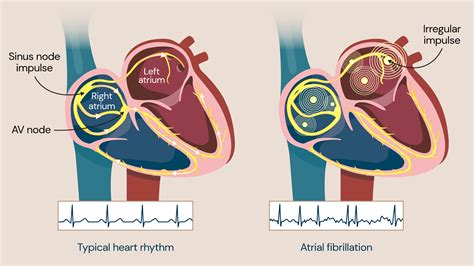 Atrial fibrillation: Symptoms, causes and treatments