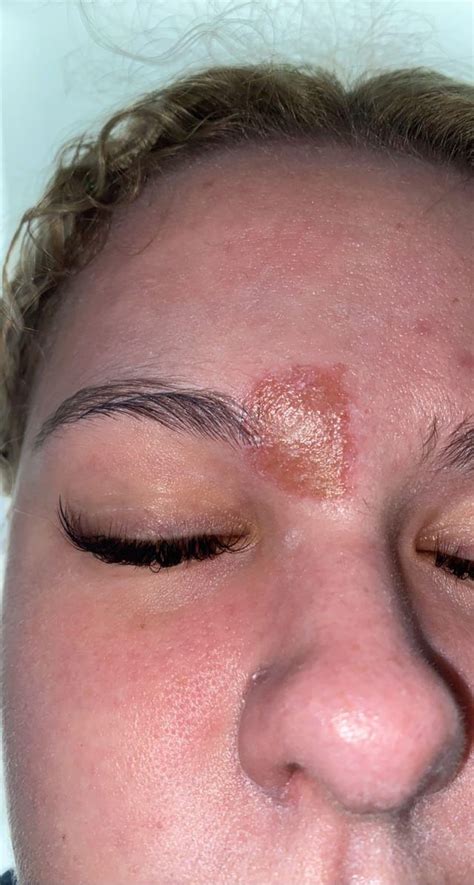 Image result for Blood Red Pimple