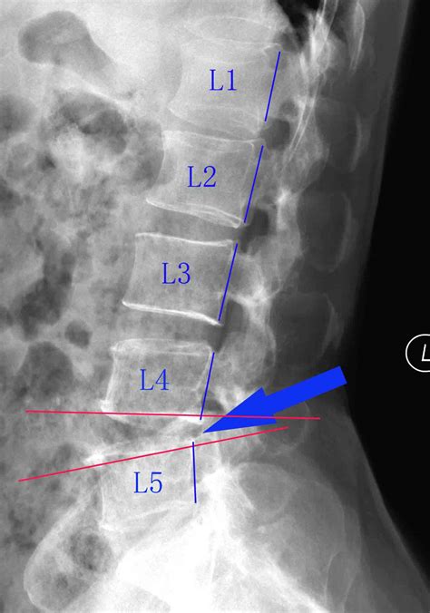 腰椎骨折经皮后路撑开复位内固定术-医联