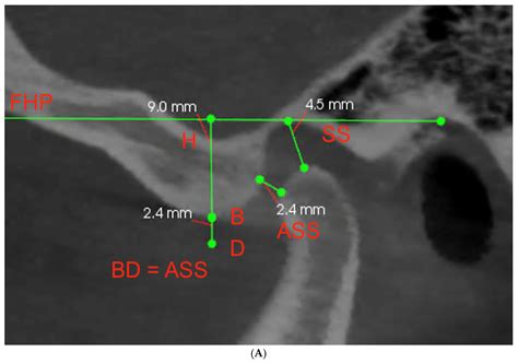 Complicated Relationships between Anterior and Condylar Guidance and ...