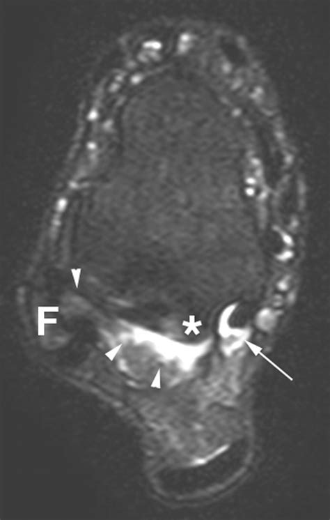 Posterior Ankle Impingement in Professional Soccer Players ...