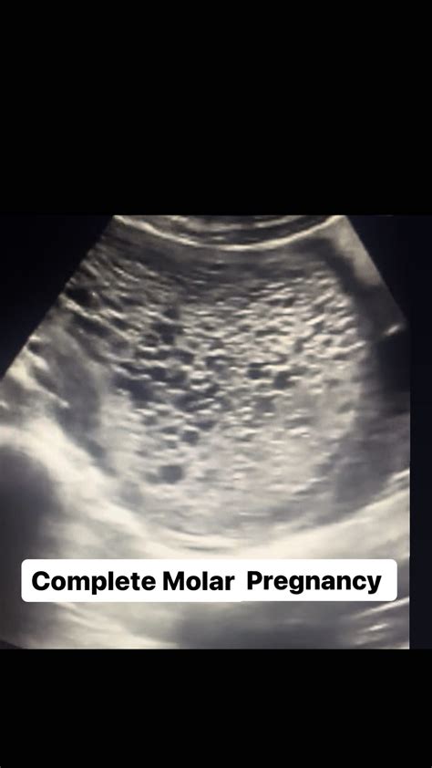 Dr.Rucha Sheth MD. | MOLAR PREGNANCY : Molar pregnancies / Hydatidiform moles, are one of the ...