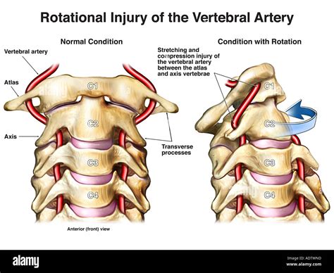 Vertebral Artery Segments