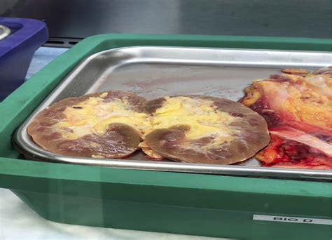 Fatty kidney disease: The importance of ectopic fat deposition and the potential value of ...