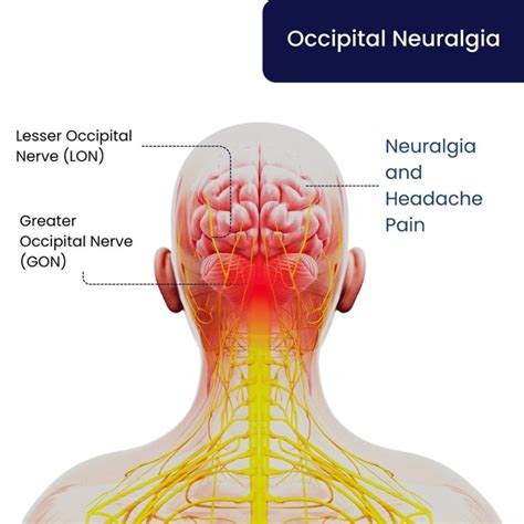 Occipital Neuralgia Treatment in Brooklyn, NYC & NJ
