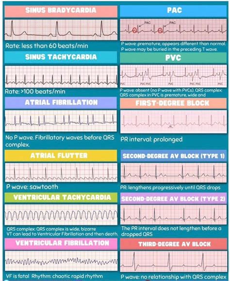 Sinus Bradycardia Vs PAC - MEDizzy