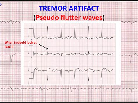 ECG ARTIFACTS AND PITFALLS | PPTX