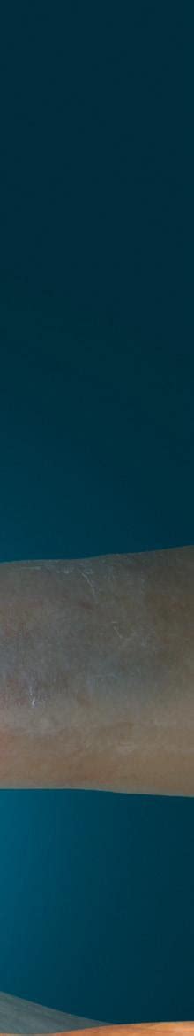 Image result for Dermal Matrix Application