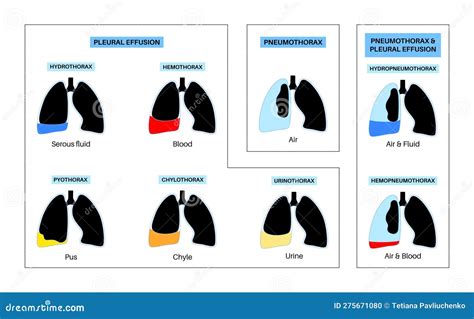 Pleural Effusion Poster Vector Illustration | CartoonDealer.com #275862880