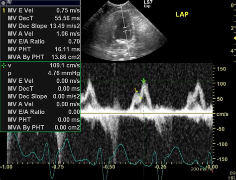 Image result for Moderate Diastolic Dysfunction