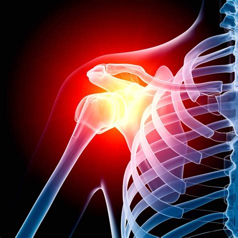 AC Joint Sprain - CARESPACE Health+Wellness