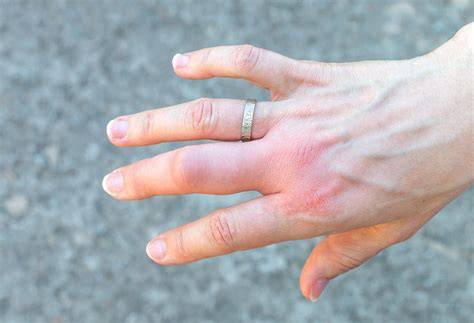 How to Know If You've Broken Your Wrist | The Well by Northwell