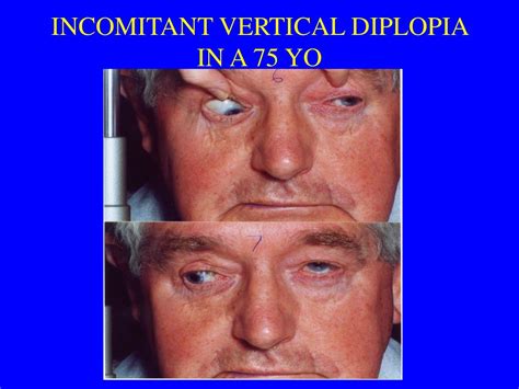 Image result for Intractable Diplopia