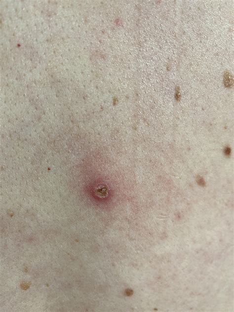 Two round scabs on back - what are these? Don’t think they’re acne ...