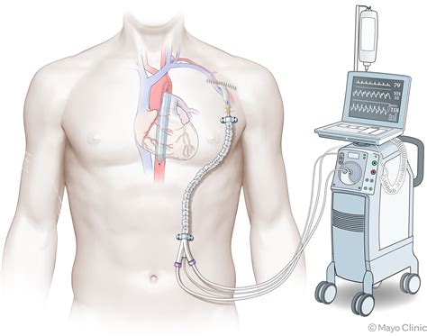 Technique of Intra-Aortic Balloon Pump Insertion through Axillary ...