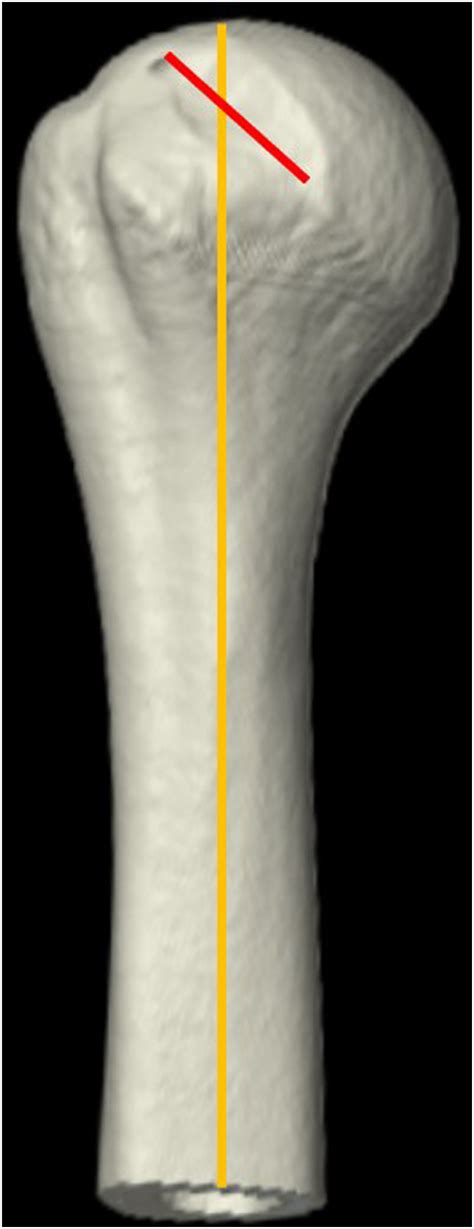 Location and size of the reverse Hill-Sachs lesion in patients with traumatic posterior shoulder ...