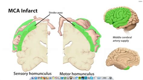 Image result for Contralateral Brain Injury