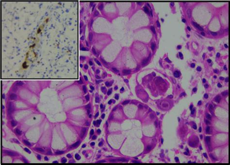 IJPO - Indian J Pathol Oncol