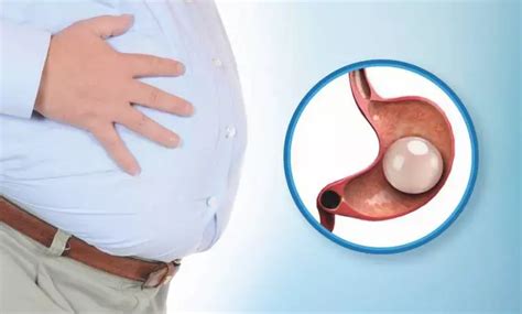 Intragastric balloons With Lifestyle Modification lead to significant ...