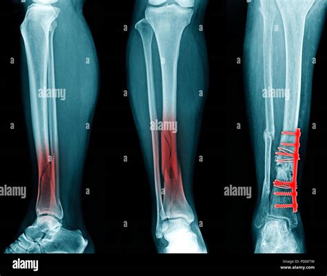 Xray Of Tibia And Fibula Fracture Stock Photo Getty Images