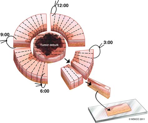 Image result for Mutilation Excision