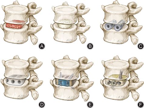 Types Of Spinal Cages at Autumn Banks blog