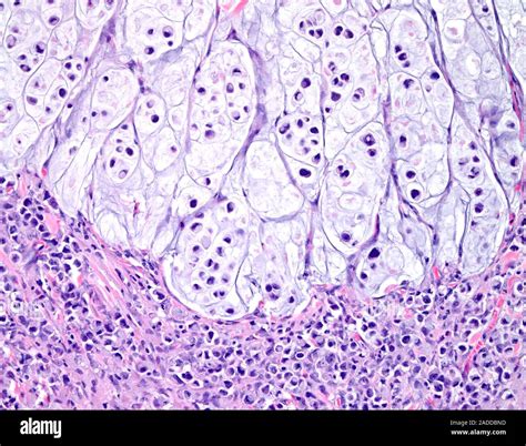 Signet ring cell carcinoma of the colon, light micrograph. This is a rare form of adenocarcinoma ...