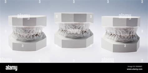 Image result for How to Take Study Models with Plaster Lab