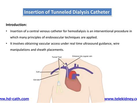 Tunneled catheter insertion | PDF