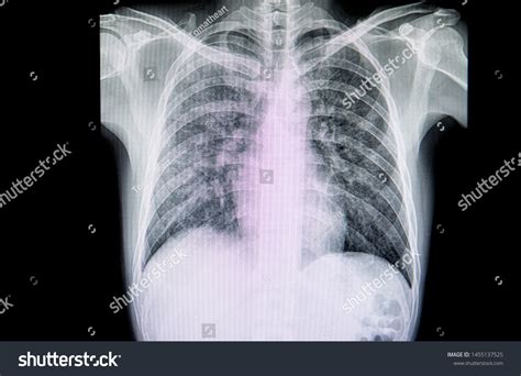 Atypical Pneumonia