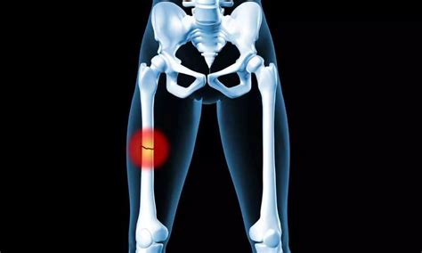 Block Pain: Study Unleashes Power of Suprainguinal Fascia Iliaca ...