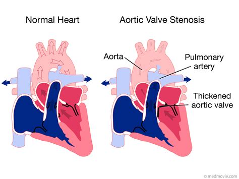 Mitral Valve: Mitral Valve Or Aortic Stenosis