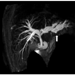 Image result for MRCP Biliary Tree