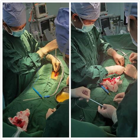 肾内科完成首例“经皮穿刺腹膜透析置管术”