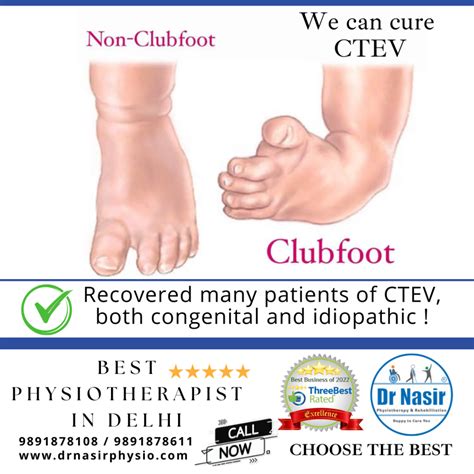 Club Foot
