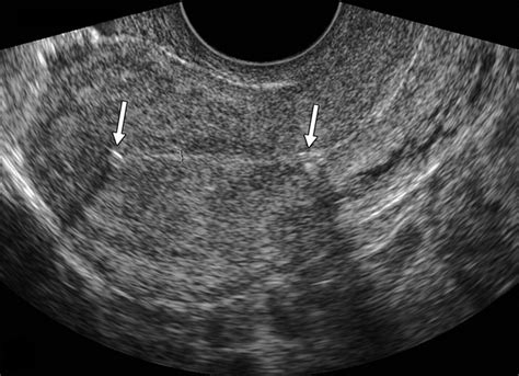Paragard Iud Ultrasound