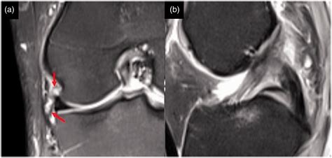 Assessment of the anterolateral ligament of the knee by 1.5 T magnetic resonance imaging ...