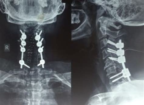 Lumbar Laminectomy With Fusion