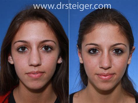 rhinoplasty to narrow nose | Steiger Facial Plastic Surgery | Boca Raton Facelift, Rhinoplasty ...