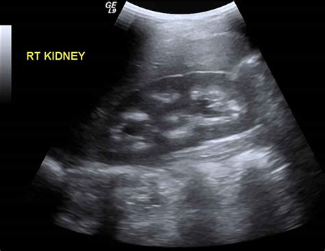 Medullary Sponge Kidney Nephrocalcinosis Ultrasound at Bobby Haley blog