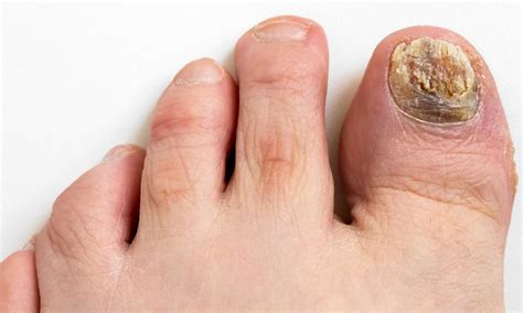 Infections in foot through dirty nails occurrence???? – HappyWalk ...