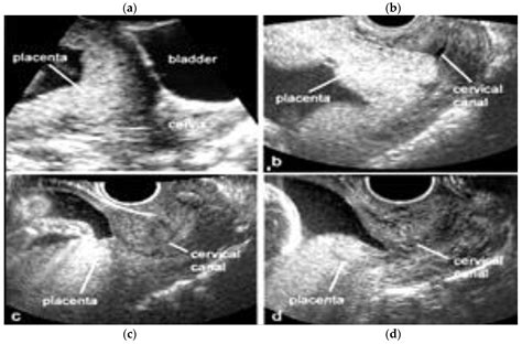 Placental and Umbilical Cord Anomalies Diagnosed by Two- and Three ...