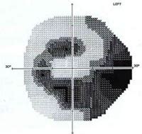 Visual Field Test – Cure Glaucoma Foundation