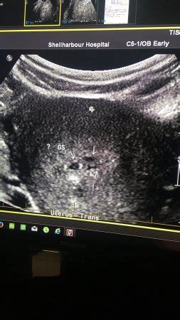 Not actually SCH but twins? | BabyCenter