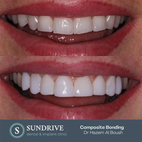 Composite Bonding - Sun Drive Dental and Implant Clinic