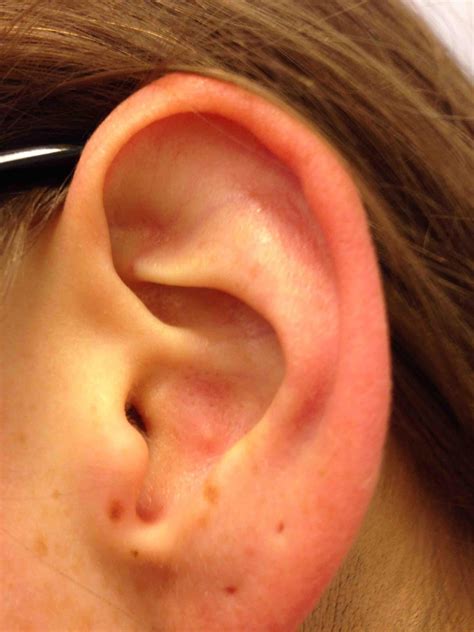 Image result for Loud Exploding Zit