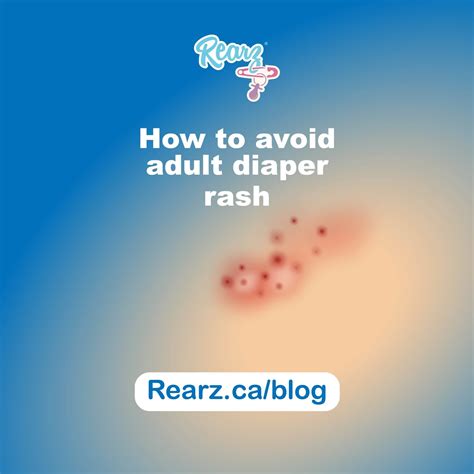 Diaper Rash Red No Bumps at Douglas Wilder blog