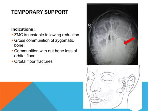Management of zygomaticomaxillary complex fractures ih | PPTX