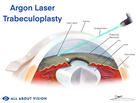 Glaucoma Laser Surgery