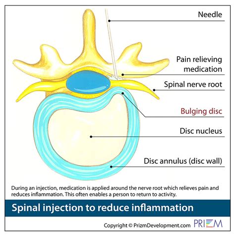 Image result for Lumbar Disc Injection